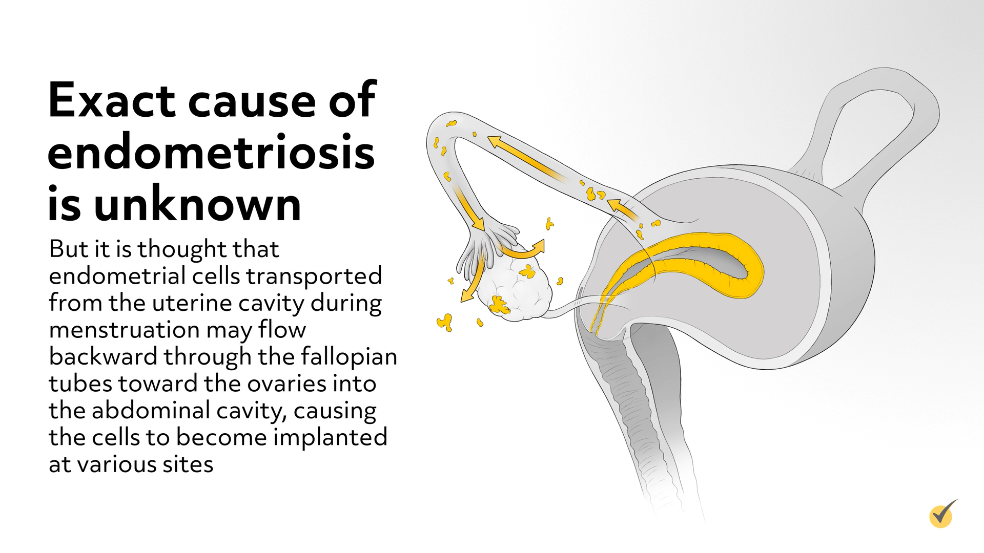 cause of endometriosis