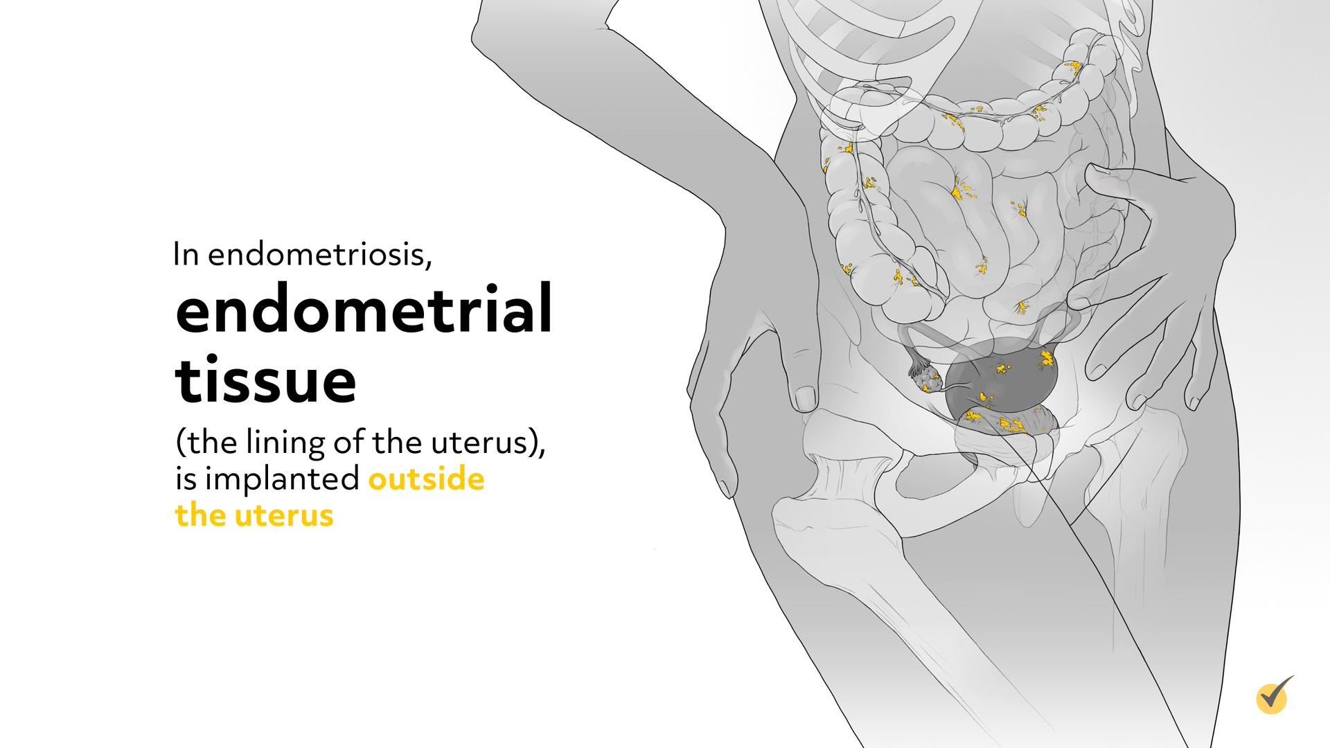 endometrial tissue