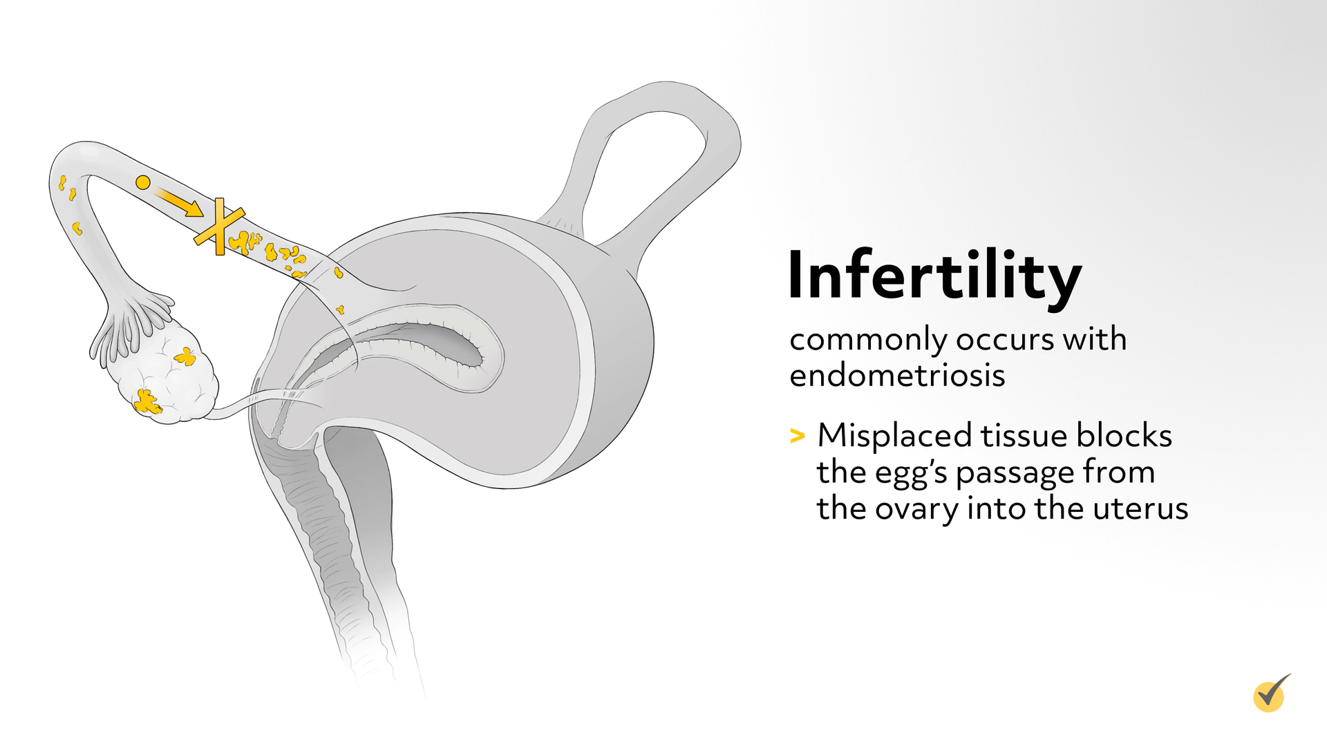 infertility