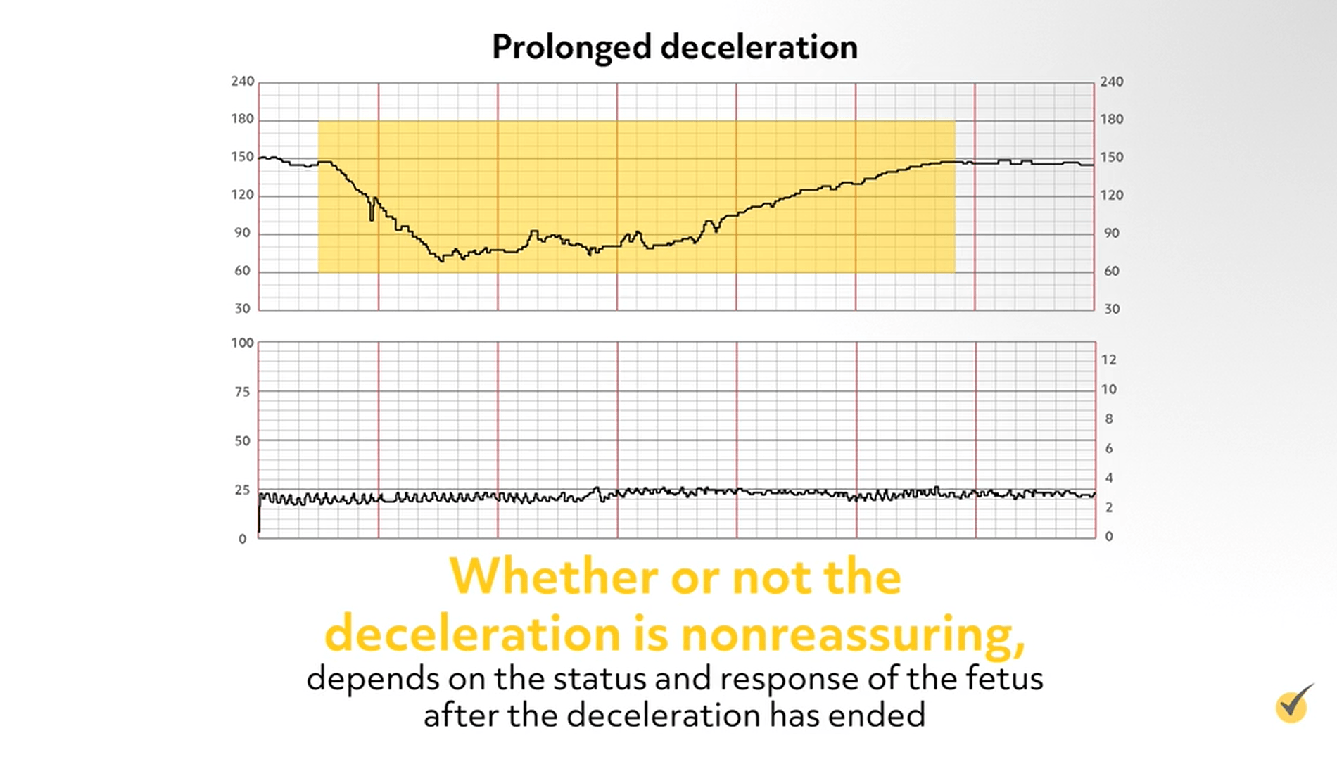 deceleration definition
