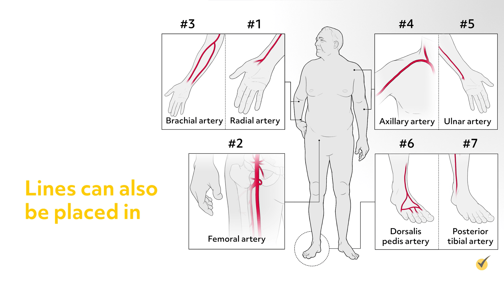 Image showing the different places you could execute an arterial puncture. 
