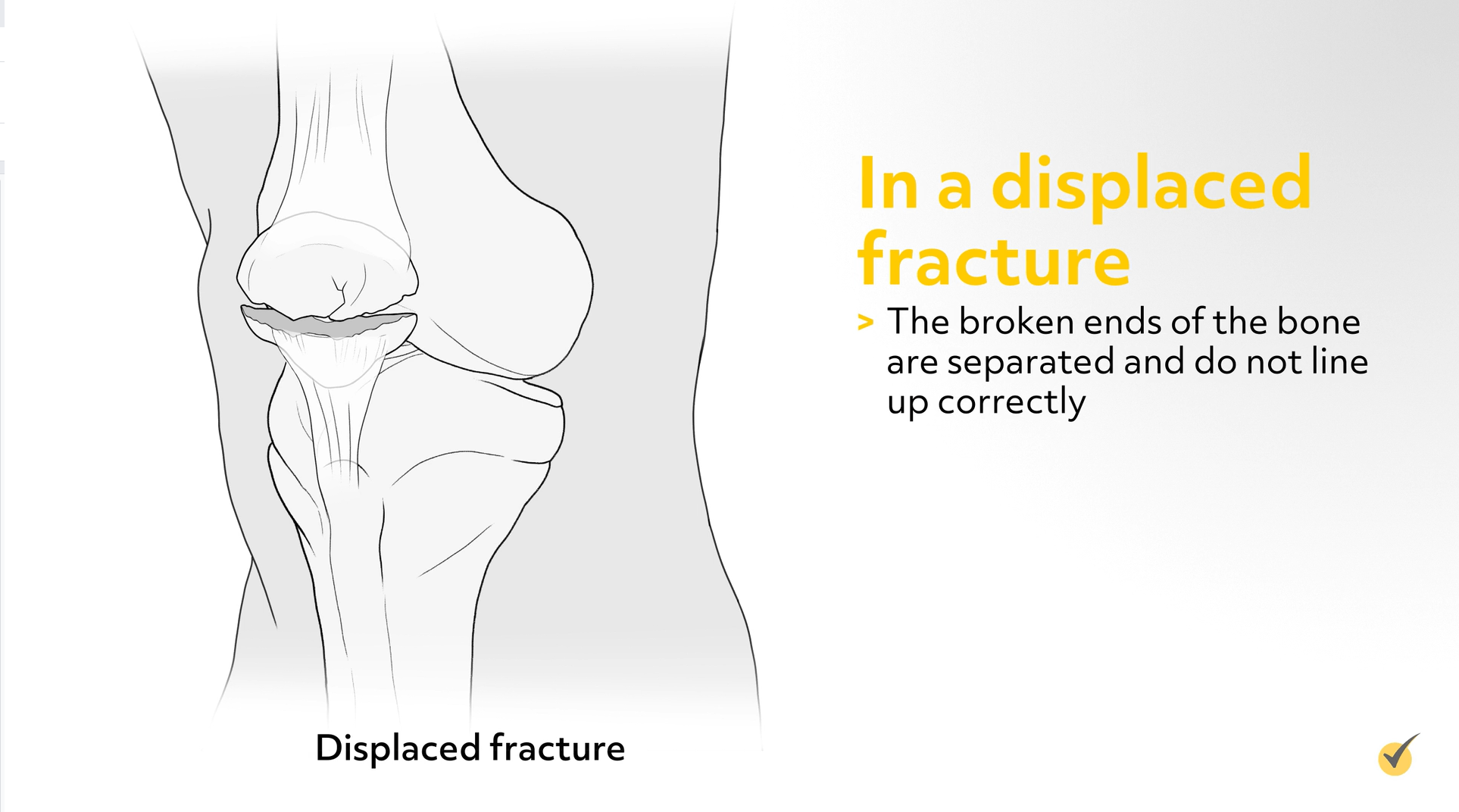 Image of a displaced fracture; this is when the broken ends of the bone are separated, and are not aligned.