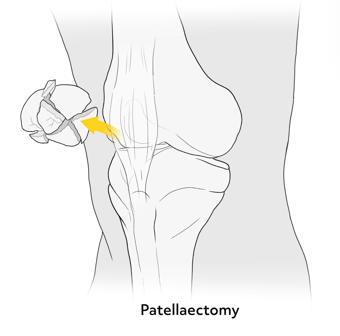 Example of a patellectomy. The broken patella is completely removed from the body.