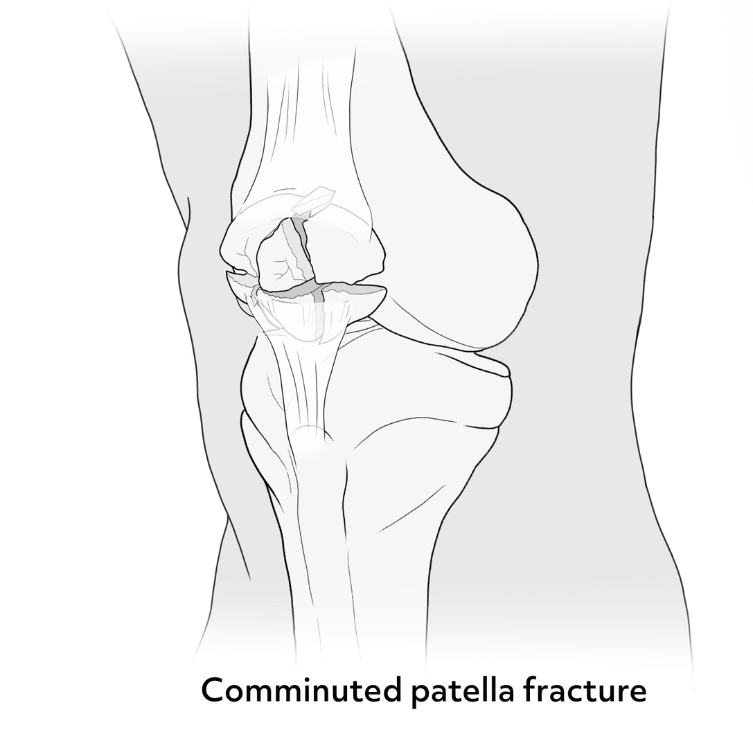 Image of a comminuted patella fracture. The bone is shattered.