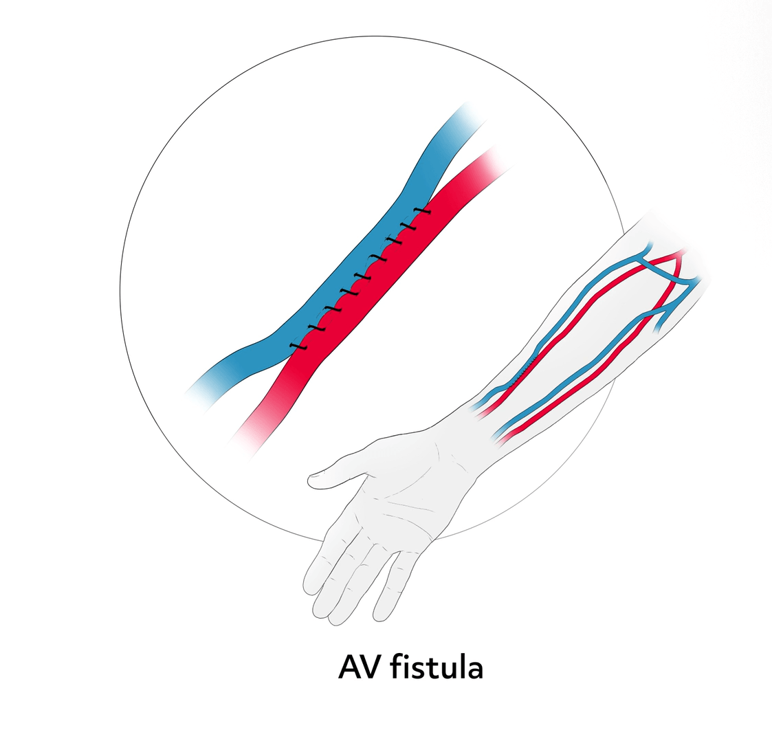 Image of an AV fistula: an artery and vein are sewn together.