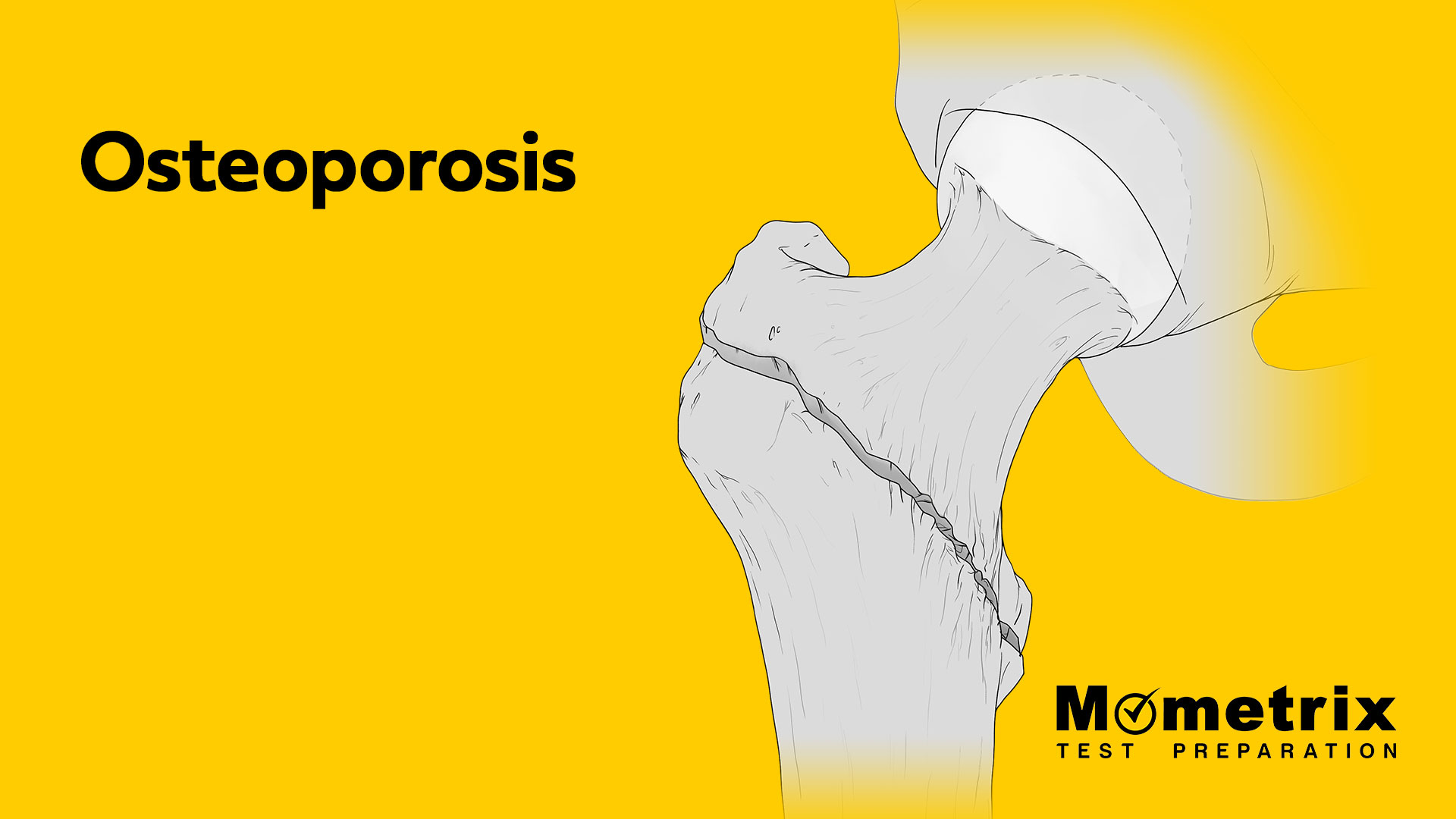 Osteoporosis [Video]