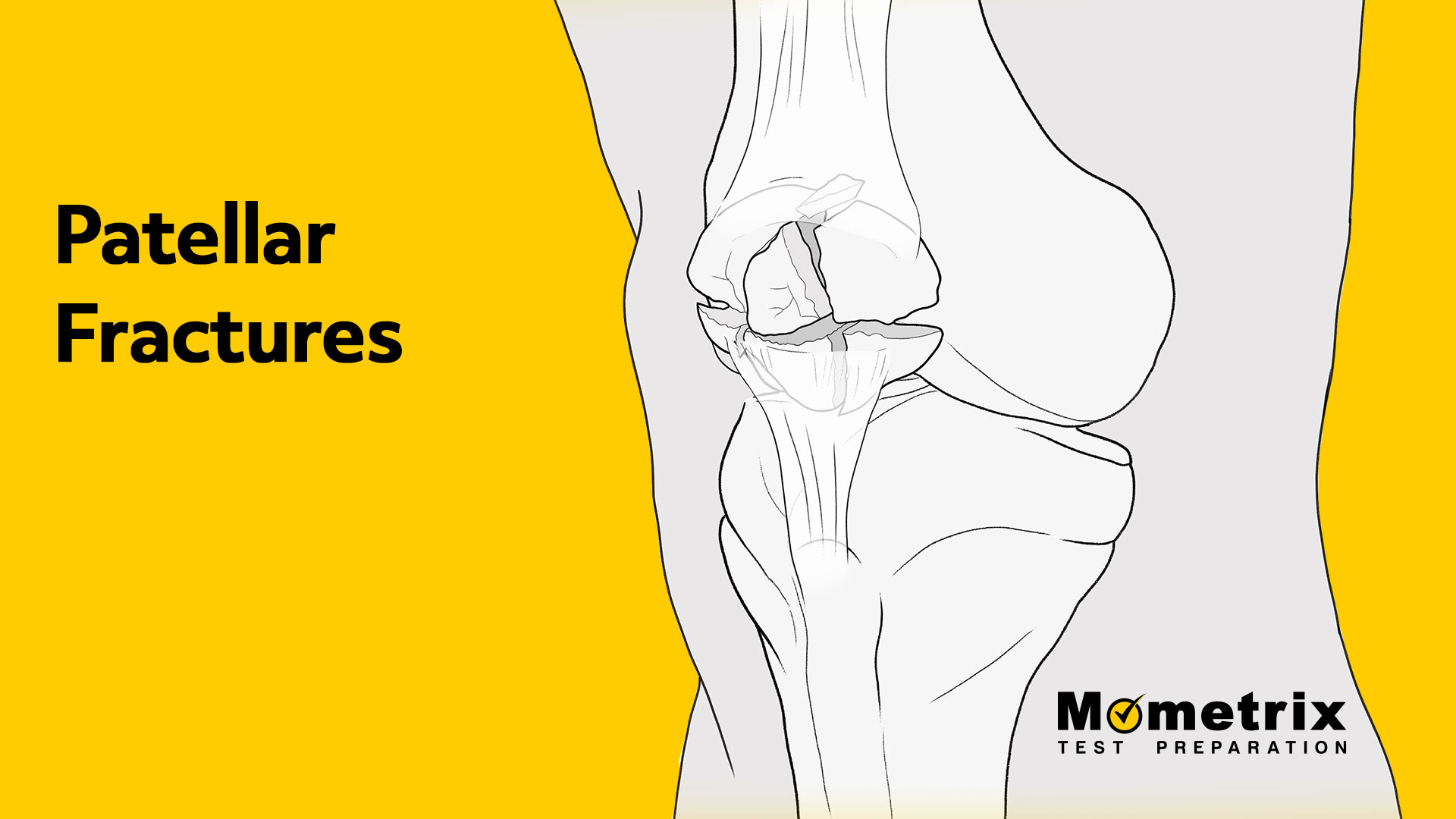 Diagram showing a patellar fracture in the knee, with text "Patellar Fractures" on a yellow background on the left and a logo "Mometrix Test Preparation" on the bottom right.