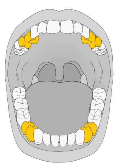 Pre-molars
