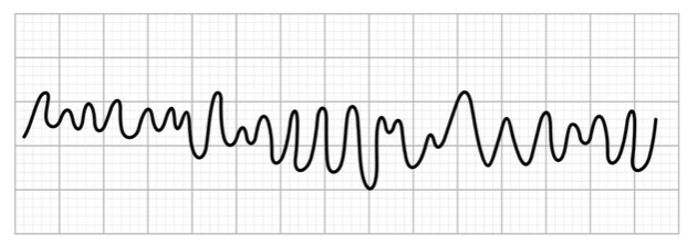 ventricular fibrillation