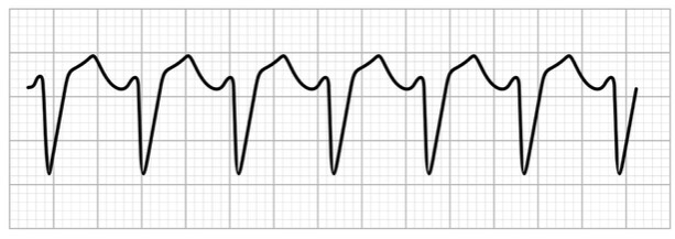 ventricular tachycardia