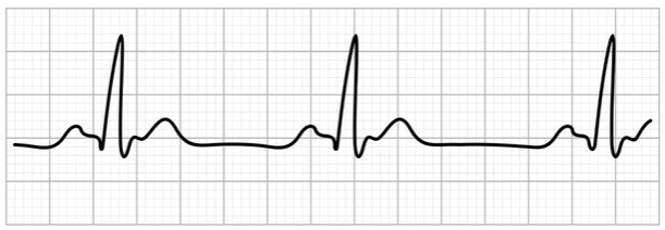 symptomatic bradycardia