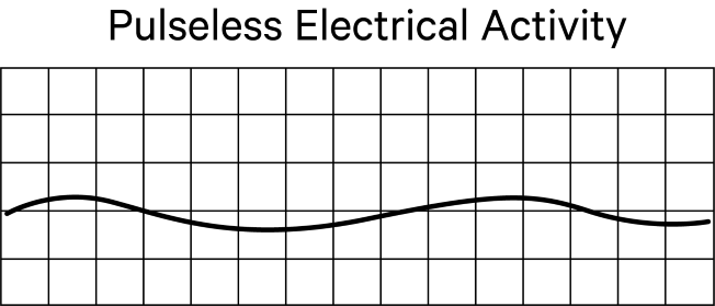 Pulseless Electrocardiogram