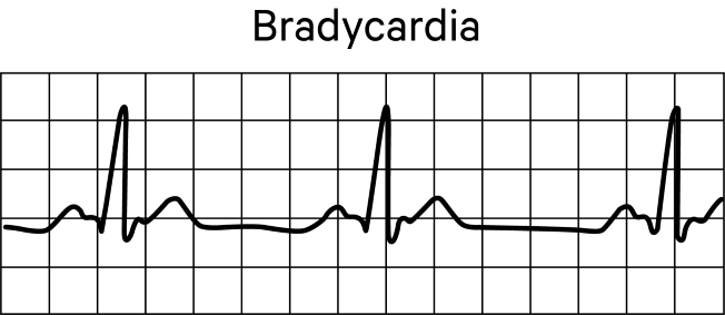 Pediatric Bradycardia